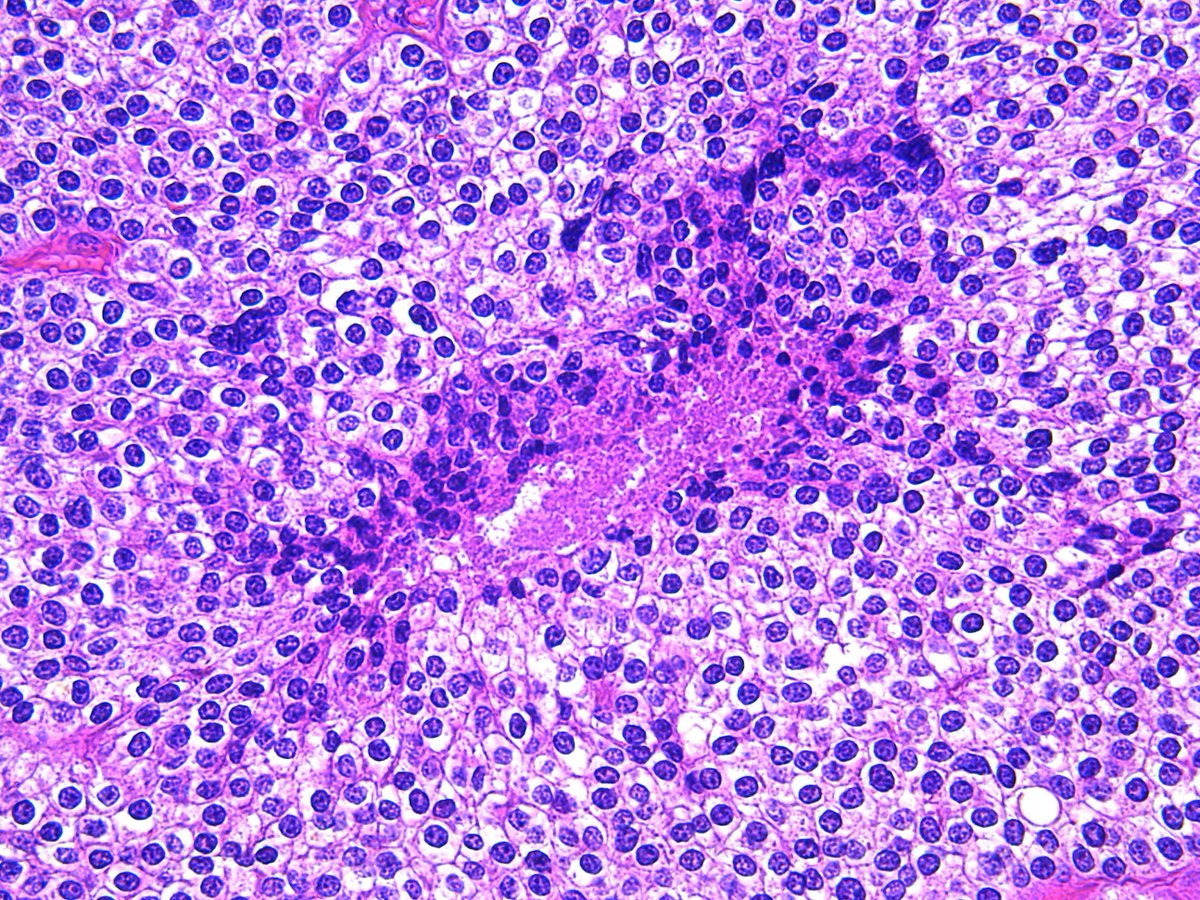 Patholwalker's tweet photo. Parathyroid carcinoma. HE and Elastica van Gieson #Pathology #Pathologist #EndPath https://t.co/lEAAatBFso