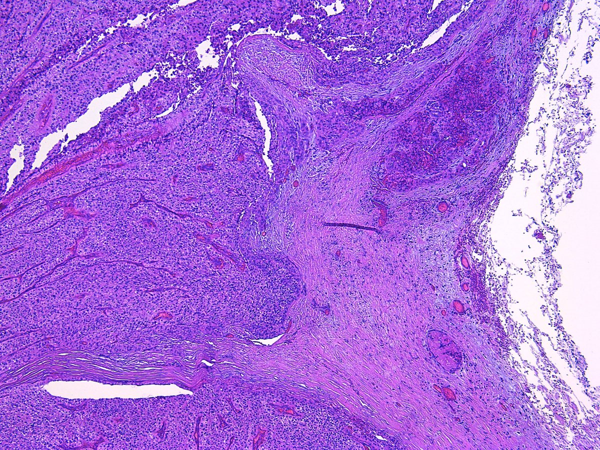 Patholwalker's tweet photo. Parathyroid carcinoma. HE and Elastica van Gieson #Pathology #Pathologist #EndPath https://t.co/lEAAatBFso