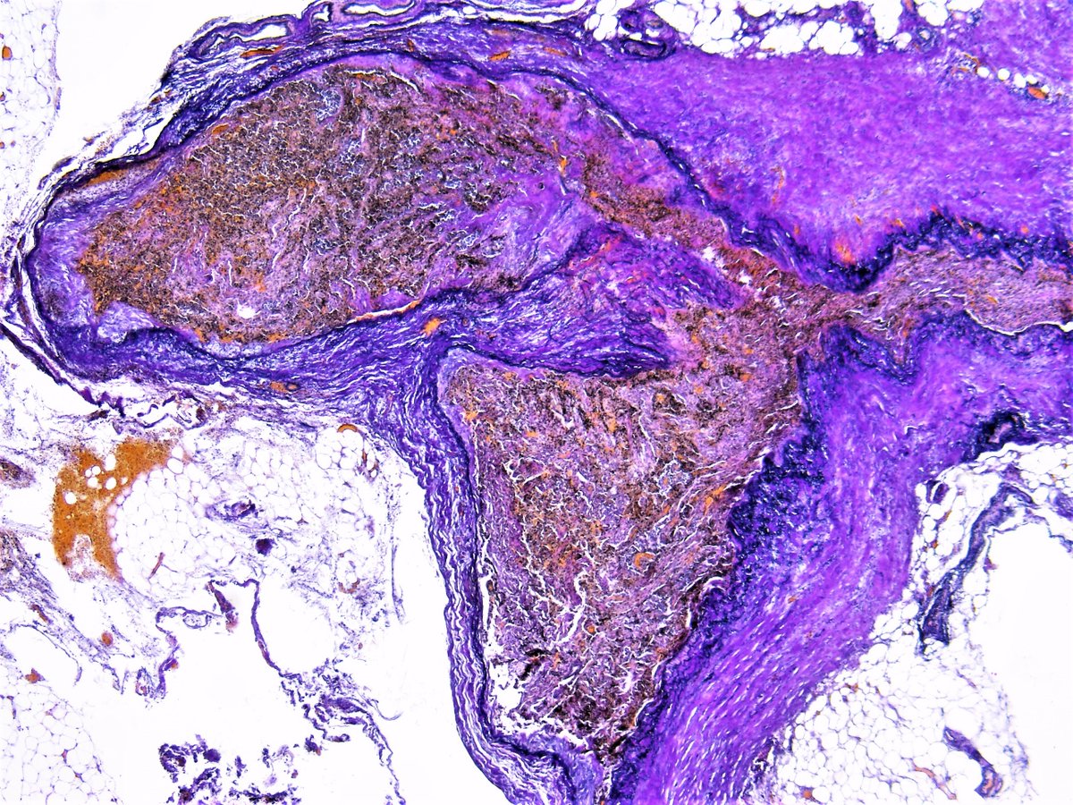 Patholwalker's tweet photo. Parathyroid carcinoma. HE and Elastica van Gieson #Pathology #Pathologist #EndPath https://t.co/lEAAatBFso