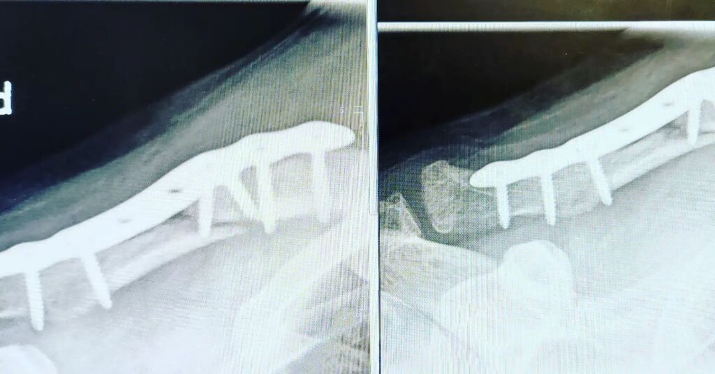 JeremiahHarm's tweet photo. Week 14 after surgery

Left is the new one. This time the chief doctor could explain a lot better what is happening. He's content and maybe I will get the medical clearance for mountainbiking in 4 weeks. Right now I'm allowed to use a normal bicycle.
I can swim, use weights,… https://t.co/kVGCZY9Ede