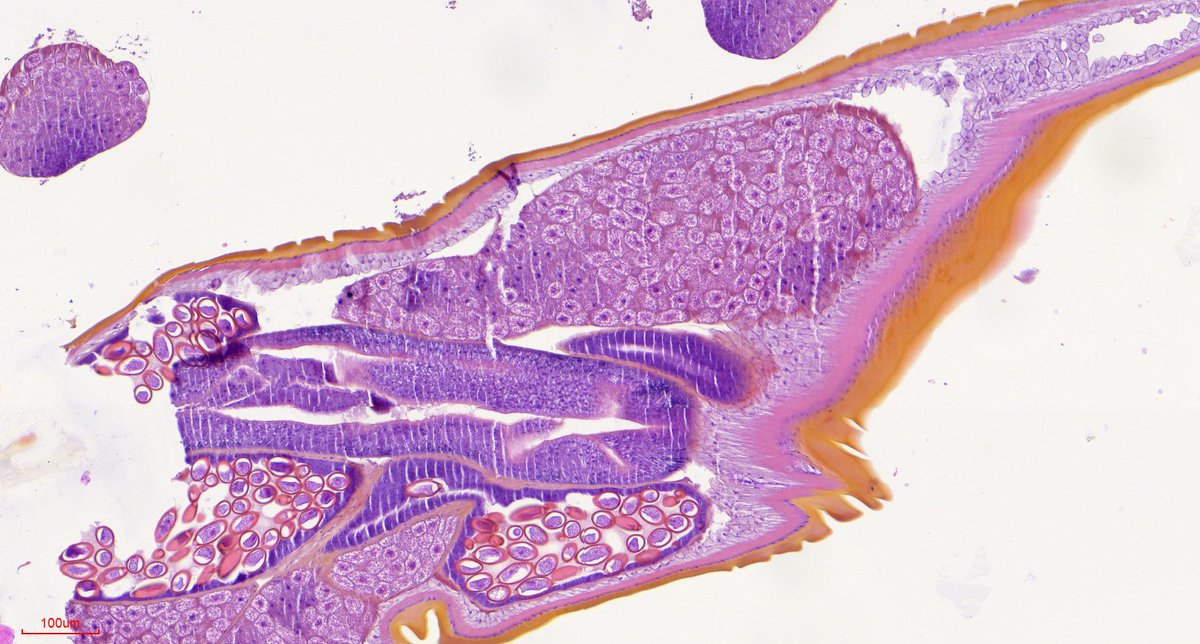 PathoPictures's tweet photo. Hello! 
A 4mm specimen found during colonoscopy (no macro photo sorry). 
Is this a hookworm? or any other idea? https://t.co/RLmi15h6lF