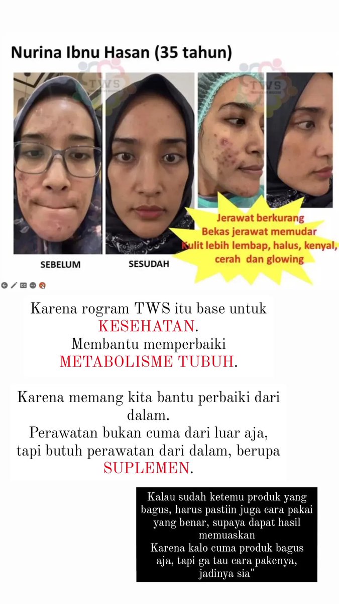 shelz_SB's tweet image. Beberapa hasil dan testimoni dari program TWS. Program yang lebih fokus untuk KESEHATAN, dengan bonus body SLIM.
Ga cuma itu aja, kalau metabolisme tubuh sudah benar, kulit wajah juga mengikuti menjadi lebih cerah dan membaik.
#twsprogram #programtws #diet #healthylifestyle