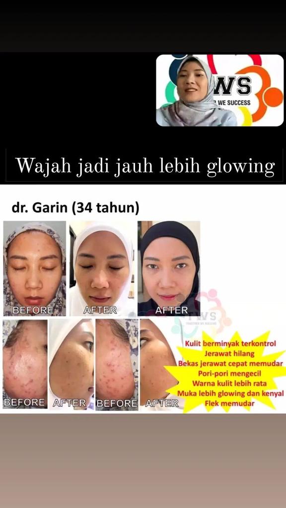 shelz_SB's tweet image. Beberapa hasil dan testimoni dari program TWS. Program yang lebih fokus untuk KESEHATAN, dengan bonus body SLIM.
Ga cuma itu aja, kalau metabolisme tubuh sudah benar, kulit wajah juga mengikuti menjadi lebih cerah dan membaik.
#twsprogram #programtws #diet #healthylifestyle