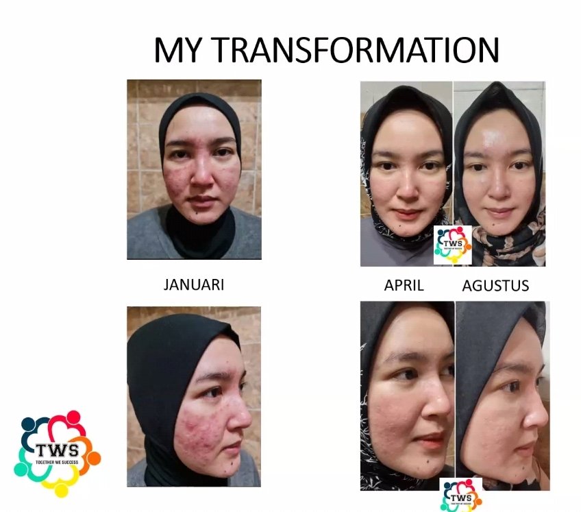 shelz_SB's tweet image. Beberapa hasil dan testimoni dari program TWS. Program yang lebih fokus untuk KESEHATAN, dengan bonus body SLIM.
Ga cuma itu aja, kalau metabolisme tubuh sudah benar, kulit wajah juga mengikuti menjadi lebih cerah dan membaik.
#twsprogram #programtws #diet #healthylifestyle