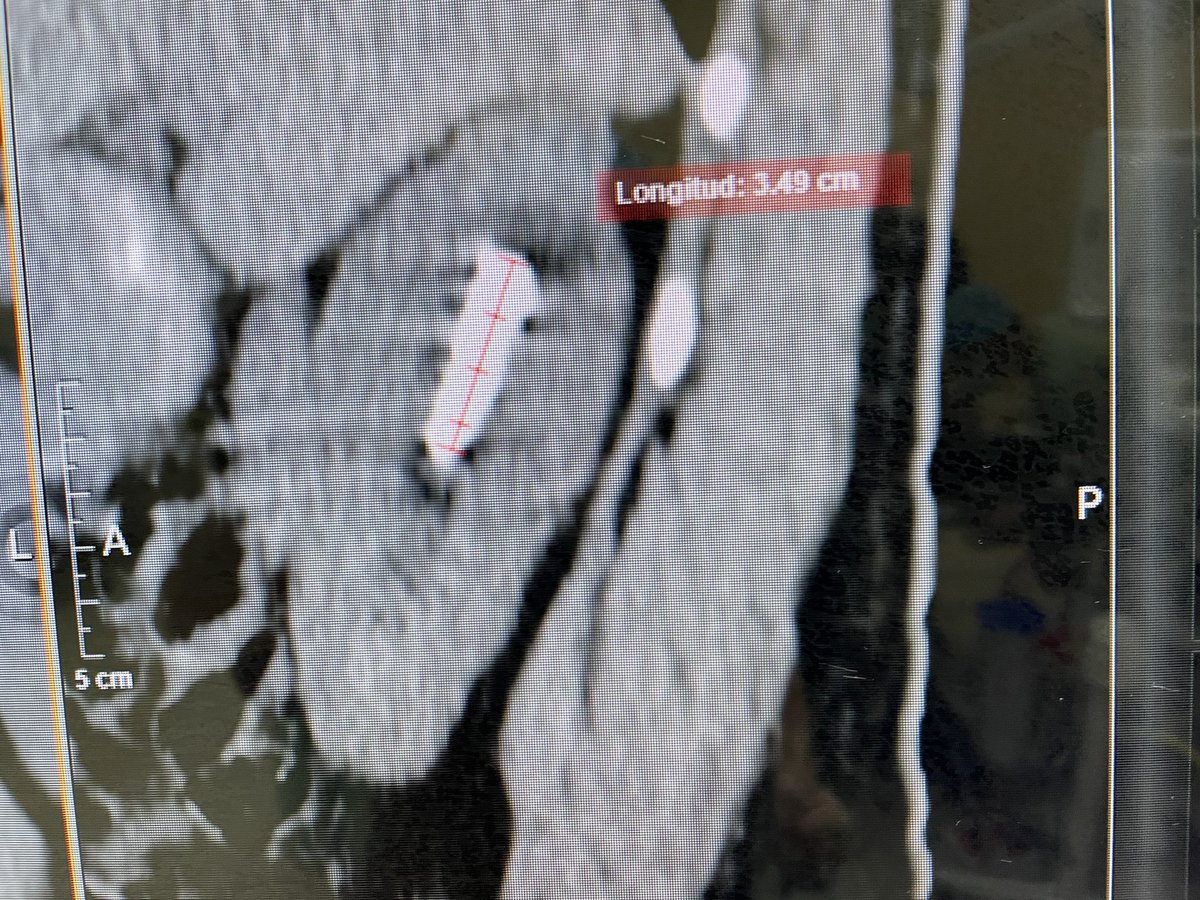 UrologoEdgar's tweet photo. Stone of the upper pole 22×37 mm with 1130 UH on average
#RIRS vs #mPCNL
As you know, I’m a PCNL fan
So I decided to make an intercostal supine 18Fr miniaturized tract and remove the stone with the use of #SMP suction BUT the importance here was to use an occlusion Catéter https://t.co/7JD0iHLL5y