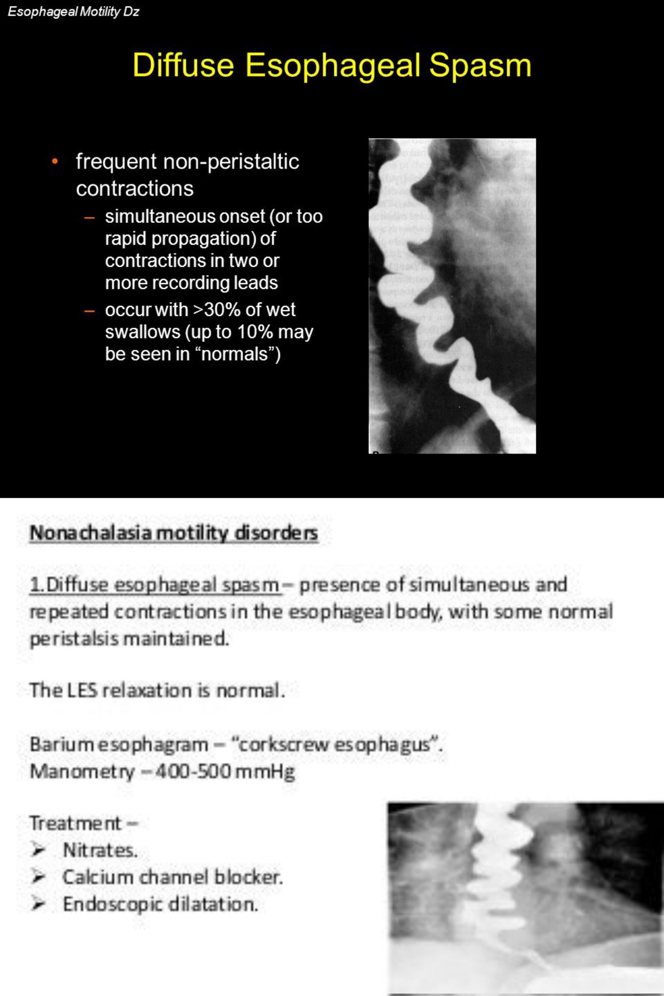 Diffuse Esophageal Spasm