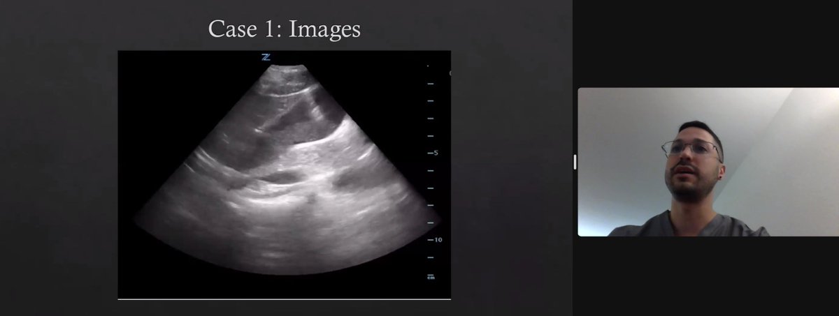 ColumbiaEMSono (@columbiaemsono) on Twitter photo Our fantastic fellows teaching the residents about abdominal ultrasound! <a href="/PennyLema/">PennyLema</a> <a href="/DiConeybeare/">Di Coneybeare</a> <a href="/JTDocintheMakin/">Jimmy Truong, DO</a> <a href="/SonoLNg/">Lorraine Ng</a> <a href="/mbrizvii/">Munaza Rizvi, MD</a> <a href="/y2kessler/">David Kessler, MD, MSc</a> <a href="/nickavitabile/">Nick Avitabile</a> Our fantastic fellows teaching the residents about abdominal ultrasound! <a href="/PennyLema/">PennyLema</a> <a href="/DiConeybeare/">Di Coneybeare</a> <a href="/JTDocintheMakin/">Jimmy Truong, DO</a> <a href="/SonoLNg/">Lorraine Ng</a> <a href="/mbrizvii/">Munaza Rizvi, MD</a> <a href="/y2kessler/">David Kessler, MD, MSc</a> <a href="/nickavitabile/">Nick Avitabile</a>