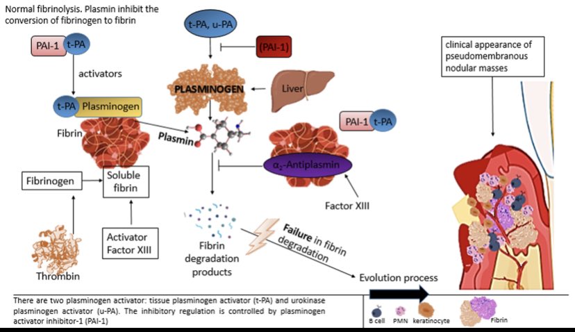 Happy with this new paper. <a href="/AnnieMcLeanDMD/">Annie McLean</a> <a href="/oralpath/">MOHAMMED N ISLAM</a> @Dr_MMagalhaes <a href="/DrGeeONE/">Olaleke Folaranmi</a> <a href="/OralWeird/">Oral Pathology "Weird & Wonderful"</a>
