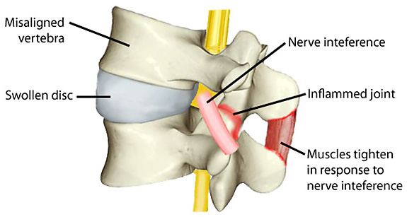 Miami_Stem_Cell's tweet photo. At Miami Stem Cell we offer no trauma, outpatient procedures to treat herniated discs using your own stem cells /  No general anesthesia / Fastest return to work / Avoid spine surgery damage / Call (305) 598-7777 or visit: https://t.co/OA60Js0upt #stemcells #prp #herniateddisc https://t.co/KbKvRU9Vgr