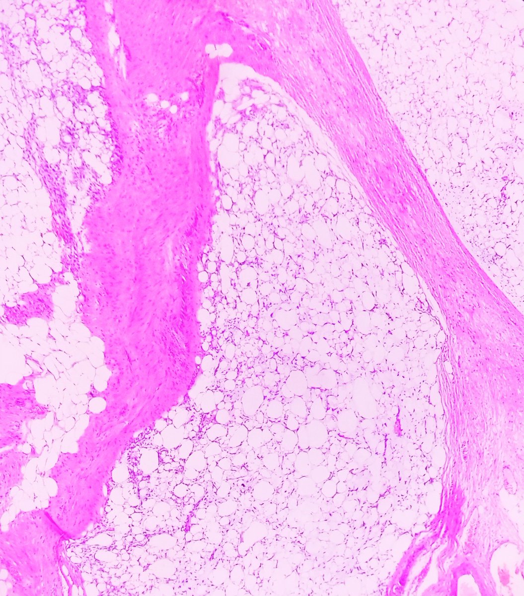 Praachy27's tweet photo. Atypical Spindle cells, lipoblasts in myxoid background-Classic for Dedifferentiated Liposarcoma. #APCON2022 #APCON2022PathTwitter @archibhat3 @adi_agnihotri @VijayPatho @smlungpathguy @FlyFan7 @padmapathology1 @Swathiprabhu5 @DrShreyapatho @DrAnilaSharma1 @mathuraiims https://t.co/x1UCJQvAef