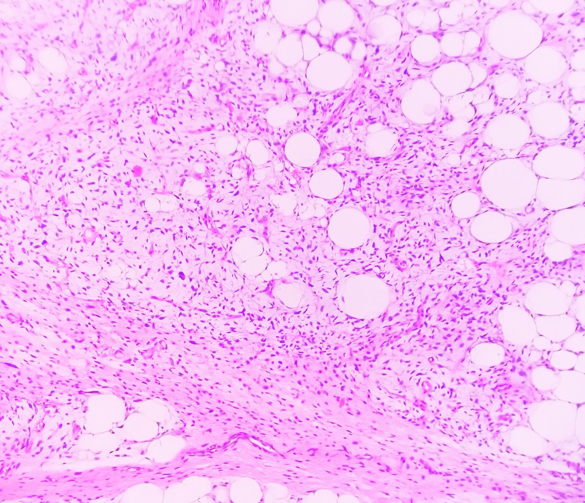 Praachy27's tweet photo. Atypical Spindle cells, lipoblasts in myxoid background-Classic for Dedifferentiated Liposarcoma. #APCON2022 #APCON2022PathTwitter @archibhat3 @adi_agnihotri @VijayPatho @smlungpathguy @FlyFan7 @padmapathology1 @Swathiprabhu5 @DrShreyapatho @DrAnilaSharma1 @mathuraiims https://t.co/x1UCJQvAef