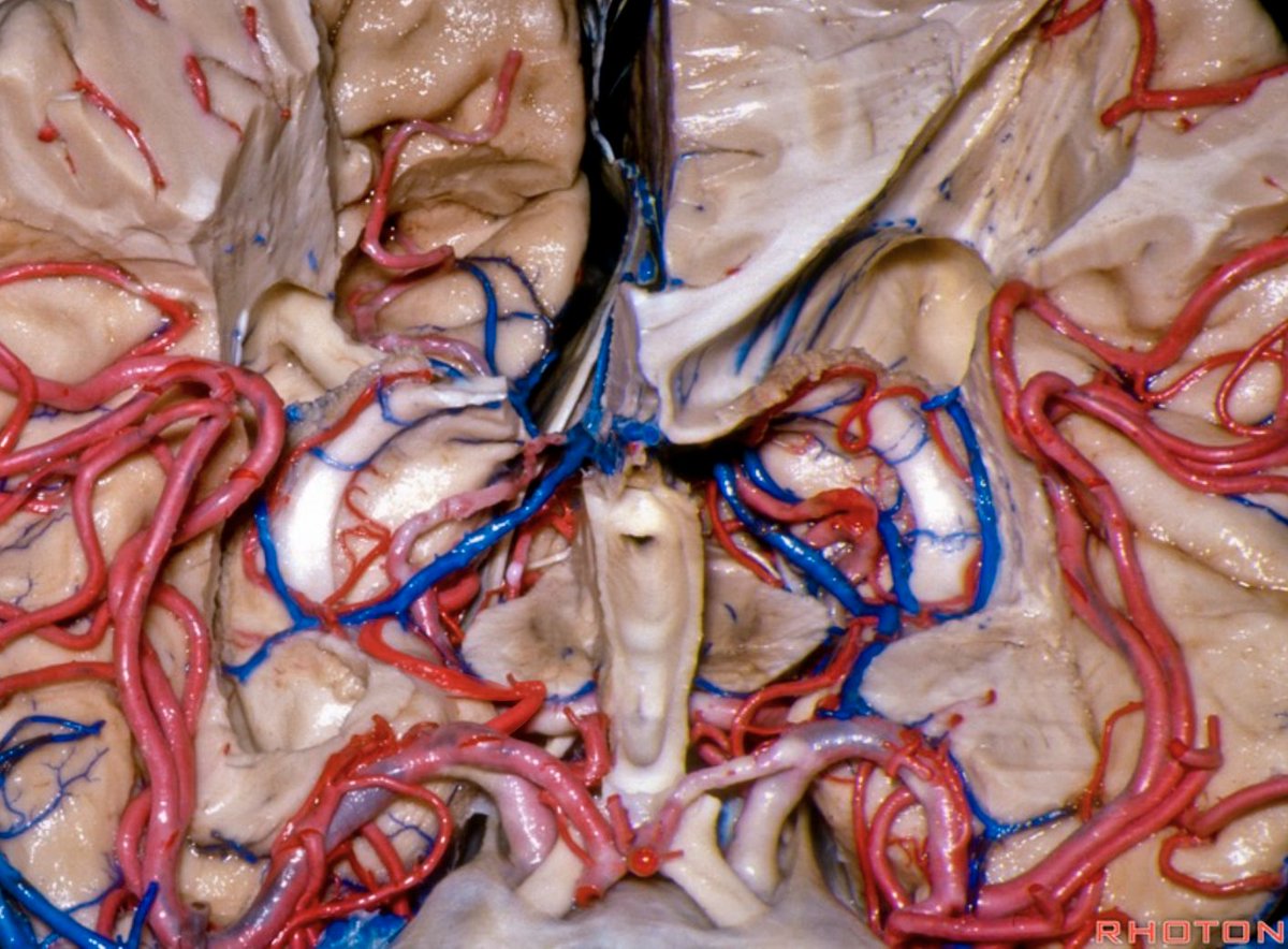 cvsection's tweet photo. The Anterior #choroidal artery supplies the uncus and choroid plexus #neuroanatomy #cerebrovascular Source: #Rhoton https://t.co/2LXirFV1e8 https://t.co/40YDmYyAGa