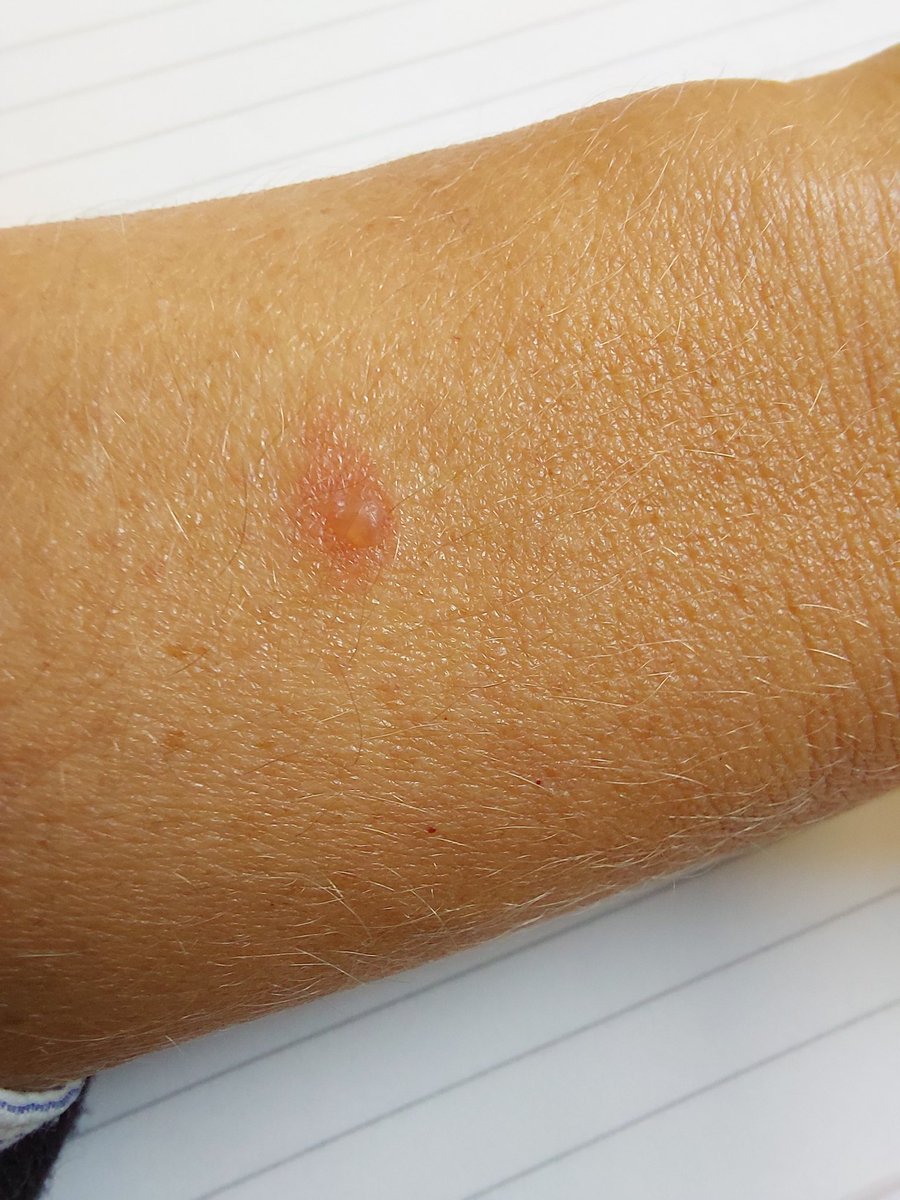 NickyVincentPH's tweet photo. @FitbitSupport So I woke this morning to a burn and blister on my wrist where my #Fitbit #Charge5 was overnight. What do you know about your overheating devices? Recalling these ones too then? https://t.co/71edBPKjIw