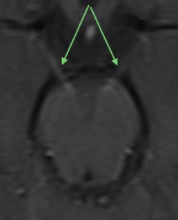 Lyell Jones MD (@lyellj) on Twitter photo Another <a href="/ContinuumAAN/">Continuum: Lifelong Learning in Neurology</a> Case!
A 21 month old girl developed esotropia and poor balance. Her initial MRI was normal. EMG revealed a demyelinating neuropathy.
She unfortunately worsened over months, with new imaging below (FLAIR/T1 post)
What’s going on, #neurotwitter? Poll in 🧵 Another <a href="/ContinuumAAN/">Continuum: Lifelong Learning in Neurology</a> Case!
A 21 month old girl developed esotropia and poor balance. Her initial MRI was normal. EMG revealed a demyelinating neuropathy.
She unfortunately worsened over months, with new imaging below (FLAIR/T1 post)
What’s going on, #neurotwitter? Poll in 🧵