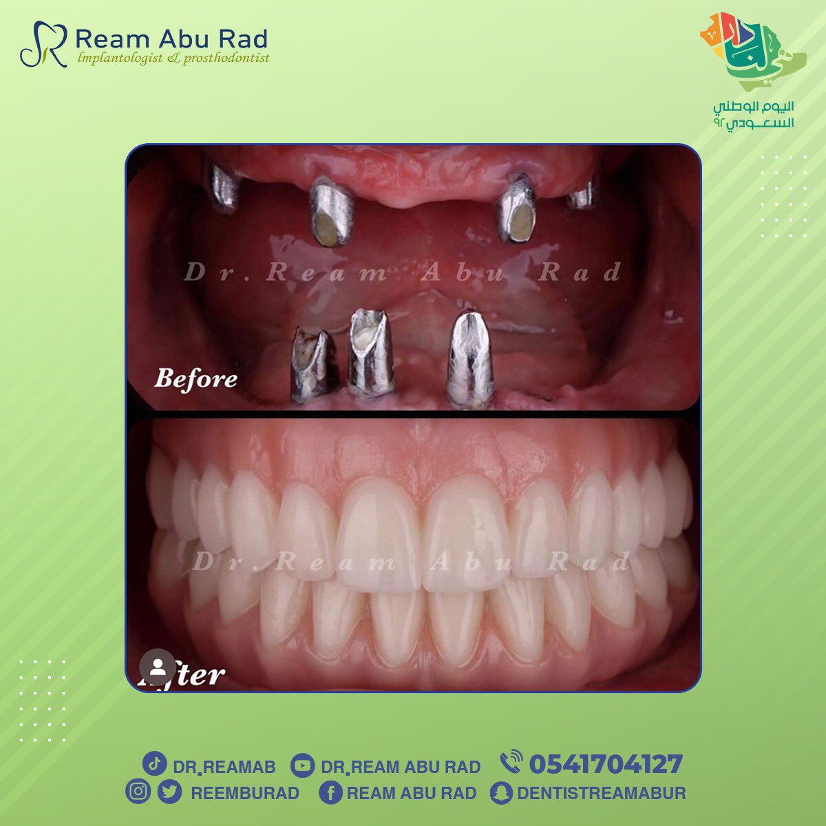 reemaburad's tweet photo. زراعة أسنان
إجراء دكتورة ريم أبو رعد

.

.

#الخبر #تجميل #علاجات #زراعة #ابتسامة #قبل_بعد #صباح_الخير #الجبيل #الشرقية #الظهران #تابعني #موسم #قرقيعان #فولو #حفلات #هوليوود #وناسة #عروض #مكياج #الكورنيش #مسائي #كود_خصم #صباح_الخير #كود #توكلنا #عرض_مادي https://t.co/iUq7blUbNQ