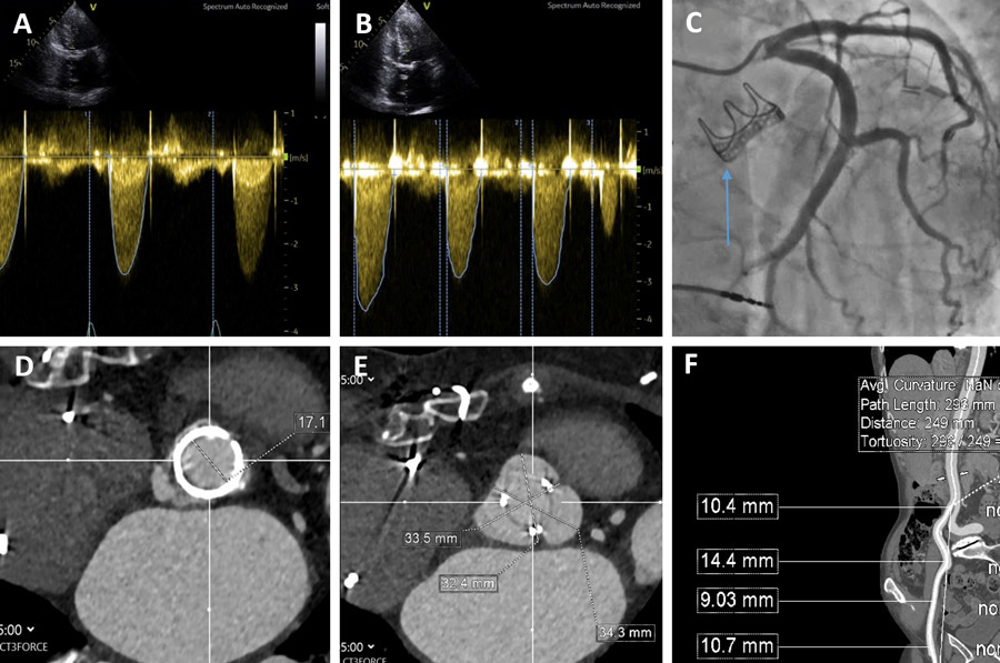 PCRonline 🫀 (@pcronline) on Twitter photo New-onset breathlessness following bioprosthetic #SAVR.
View part 1 of this new case shared by <a href="/drtpatterson/">Tiffany Patterson</a> & participate in the poll 📊 to show if you can determine the cause of this patient's symptoms!
What would your treatment strategy be?
pcronline.com/Cases-resource… New-onset breathlessness following bioprosthetic #SAVR.
View part 1 of this new case shared by <a href="/drtpatterson/">Tiffany Patterson</a> & participate in the poll 📊 to show if you can determine the cause of this patient's symptoms!
What would your treatment strategy be?
pcronline.com/Cases-resource…