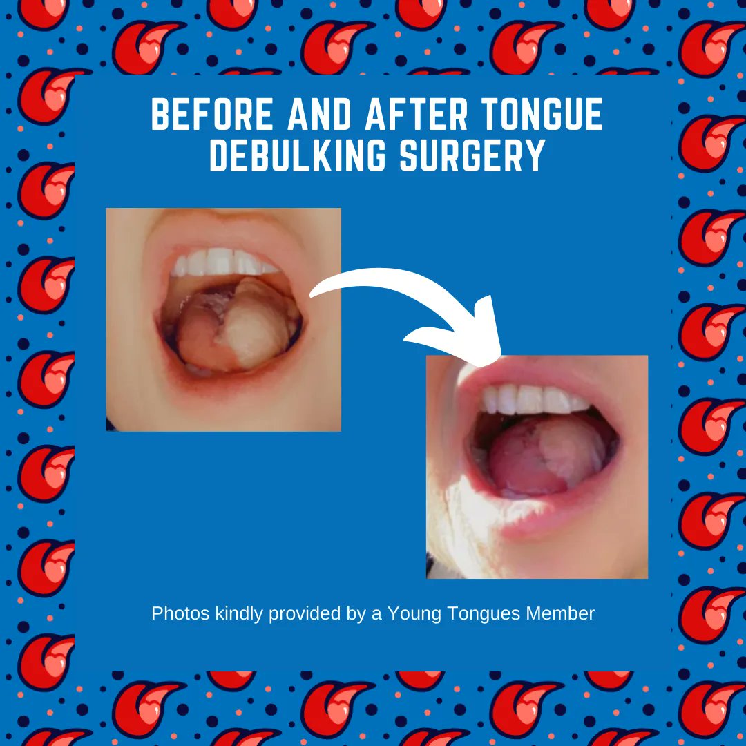 YoungTongues_'s tweet photo. Do you think your flap feels too large in your mouth? It's something that happens to quite a few Young Tongues and can be corrected by a revision surgery called debulking.
#TongueCancer #OralCancer #OralCancerAwareness #Mouthcancer #OralHealth #TongueFlapDebulking #Debulking https://t.co/2rulKoJ4qv