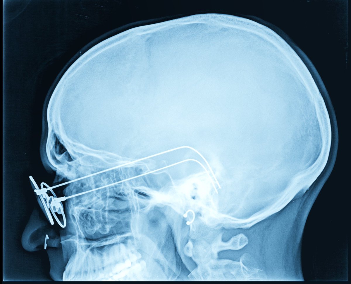 pedrodasilvath's tweet photo. CASE OF STUDY: Killa Was Here 🩻🦋

Series of real X-Ray captures from @killa_was_here https://t.co/pYQDMEFIlY