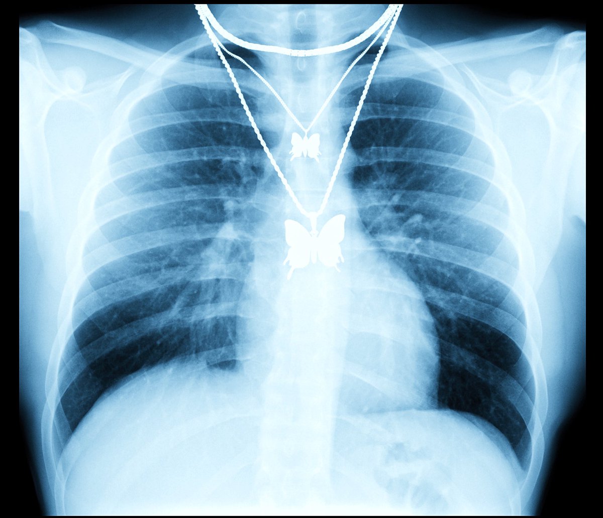 CASE OF STUDY: Killa Was Here 🩻🦋

Series of real X-Ray captures from <a href="/killa_was_here/">Killa Was Here</a>