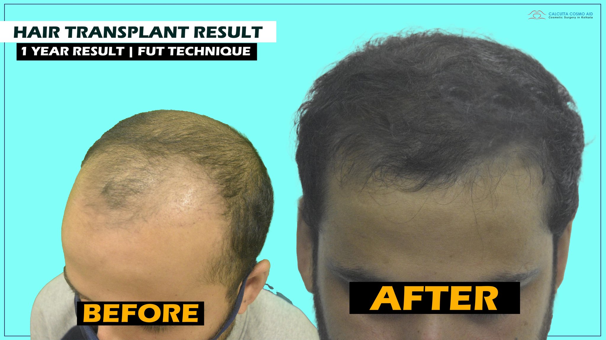 Dr Anand K Nagwani - Hair Transplant on Twitter: Dr Anand K Nagwani - Hair Transplant on Twitter: