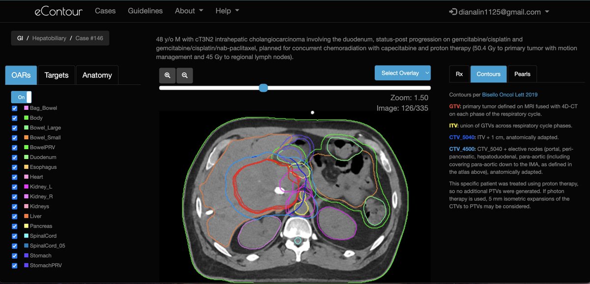 ✅ out our newest intrahepatic cholangiocarcinoma case now ➡️ econtour.org/cases/146! 🙏 to David Qian & @EmoryRadOncRes for the ⭐️ case! @ARRO_org @ACROresident @ACRORadOnc