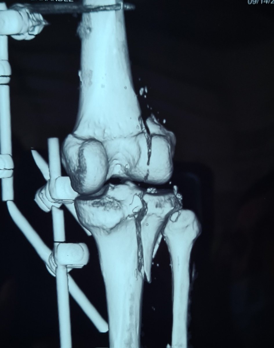 G3RSONV's tweet photo. help #orthotwitter open fracture, soft tissue ready for definitive fixation... how to address that posterolateral tibial fragment? Frosch?, extended Lobenhoffer?, extended anterolateral? https://t.co/SEb3KswMsK
