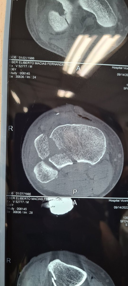 G3RSONV's tweet photo. help #orthotwitter open fracture, soft tissue ready for definitive fixation... how to address that posterolateral tibial fragment? Frosch?, extended Lobenhoffer?, extended anterolateral? https://t.co/SEb3KswMsK