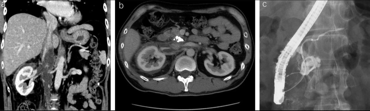 Gastronaut__'s tweet photo. Floating Inferior Vena Cava: An Unusual Presentation of Pancreatitis in the latest ACG Journal 

https://t.co/ucKvFJRRSt 

@AmCollegeGastro @ACGCRJ https://t.co/ugDS4IFADW