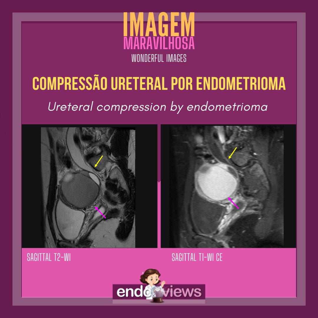 endoviews's tweet photo. Compressão ureteral por endometrioma
Ureteral compression by endometrioma
Dra. Luciana Chamié - @lucianachamiec1
Dra. Izabela Pires Franco - @izabelapfranco
Dra. Alice Brandão -
🔮Endoviews. O seu banco de imagem em endometriose.
🔮Endoviews. Your image database on endometriosis. https://t.co/7ulyQN7Mtx