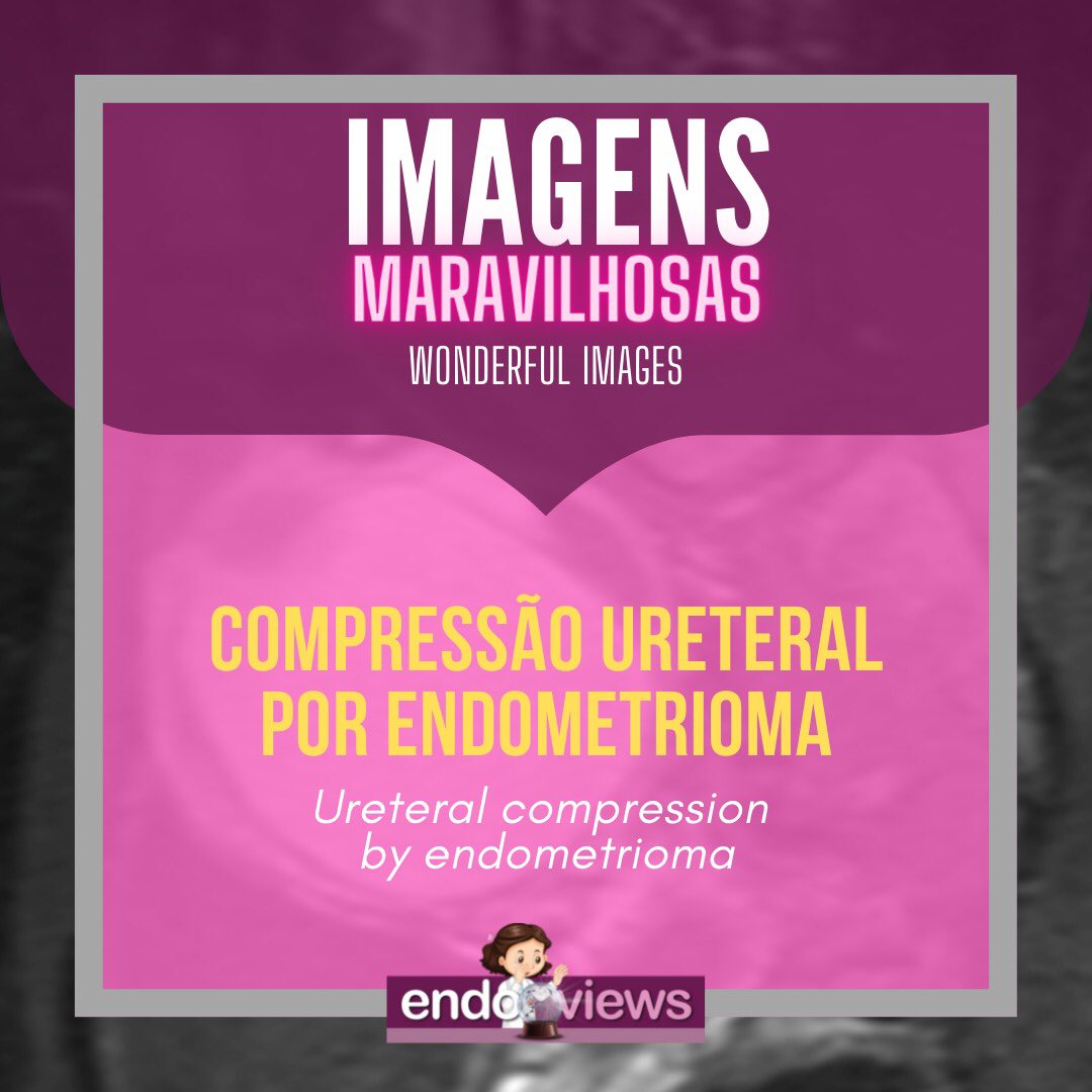 endoviews's tweet photo. Compressão ureteral por endometrioma
Ureteral compression by endometrioma
Dra. Luciana Chamié - @lucianachamiec1
Dra. Izabela Pires Franco - @izabelapfranco
Dra. Alice Brandão -
🔮Endoviews. O seu banco de imagem em endometriose.
🔮Endoviews. Your image database on endometriosis. https://t.co/7ulyQN7Mtx