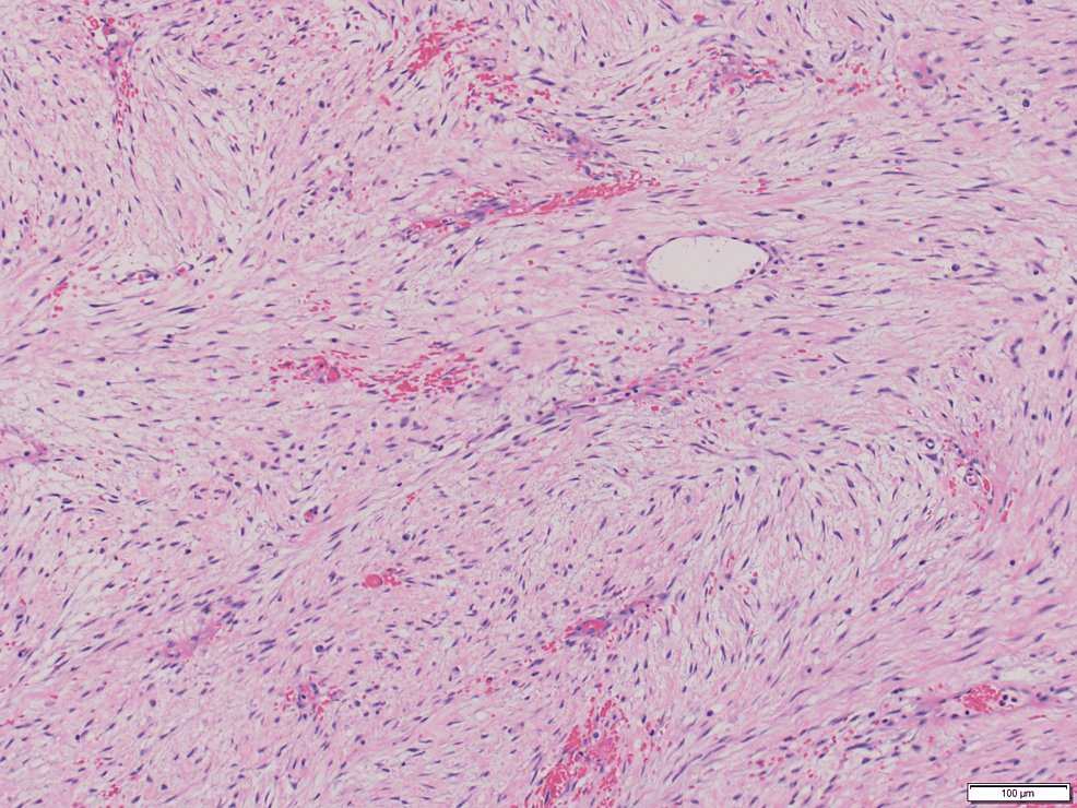 CureusMedical's tweet photo. Biclonal Desmoid-Type Fibromatosis With Two Beta-Catenin Mutations: Evidence for the Recruitment of Normal Myofibroblasts
https://t.co/75vQZvpYgL
#Pathology #pathologist #Oncology #oncologist #medtwitter #meded #foamed #Orthopedics https://t.co/DSHhkqyPXJ