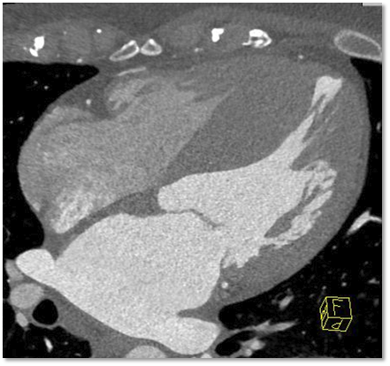 Stephan Achenbach (@steph_achenbach) on Twitter photo Hypertrophic cardiomyopathy (HOCM) on cardiac CT
#cardiotwitter <a href="/escardio/">European Society of Cardiology</a> <a href="/M_Ijgua/">Mohamed Cherif Ijgua</a> <a href="/M_Marwan_/">Mohamed Marwan</a> <a href="/CardiacCTGuy/">Maros Ferencik</a> <a href="/Heart_SCCT/">Heart_SCCT</a> <a href="/FiRSTSCCT/">FiRST - SCCT</a> <a href="/Drroxmehran/">Dr Roxana Mehran</a> <a href="/mirvatalasnag/">MIЯVΛƬ #IC</a> <a href="/HolgerNef/">Holger Nef</a> <a href="/BudoffMd/">Matthew Budoff MD</a> <a href="/mgwfriedrich/">Matthias Friedrich</a> <a href="/BayerMatthias/">M. Bayer</a> <a href="/JEscaned/">Javier Escaned</a> <a href="/thiele_holger/">Holger Thiele</a> <a href="/YoungDgk/">Young DGK</a> Hypertrophic cardiomyopathy (HOCM) on cardiac CT
#cardiotwitter <a href="/escardio/">European Society of Cardiology</a> <a href="/M_Ijgua/">Mohamed Cherif Ijgua</a> <a href="/M_Marwan_/">Mohamed Marwan</a> <a href="/CardiacCTGuy/">Maros Ferencik</a> <a href="/Heart_SCCT/">Heart_SCCT</a> <a href="/FiRSTSCCT/">FiRST - SCCT</a> <a href="/Drroxmehran/">Dr Roxana Mehran</a> <a href="/mirvatalasnag/">MIЯVΛƬ #IC</a> <a href="/HolgerNef/">Holger Nef</a> <a href="/BudoffMd/">Matthew Budoff MD</a> <a href="/mgwfriedrich/">Matthias Friedrich</a> <a href="/BayerMatthias/">M. Bayer</a> <a href="/JEscaned/">Javier Escaned</a> <a href="/thiele_holger/">Holger Thiele</a> <a href="/YoungDgk/">Young DGK</a>