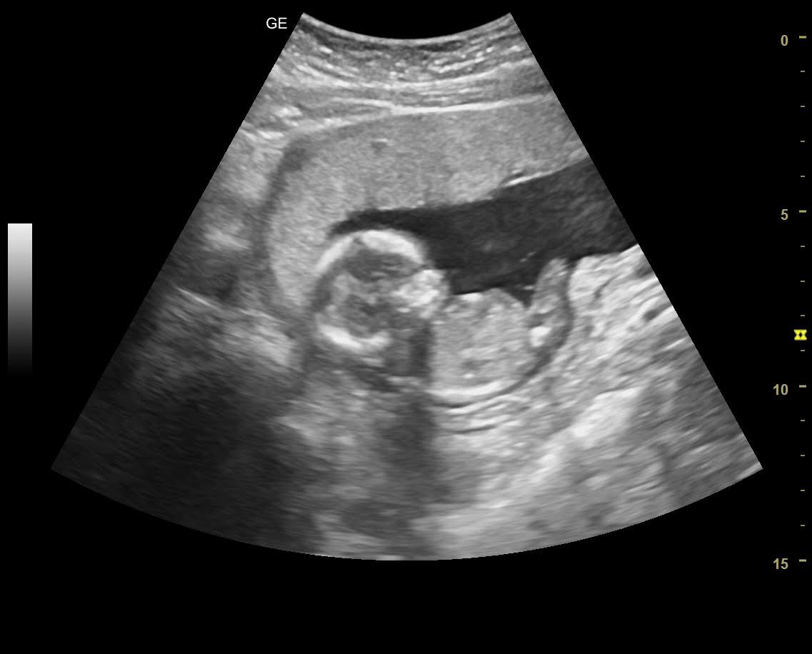 i meet my best friend in february 👑❤️