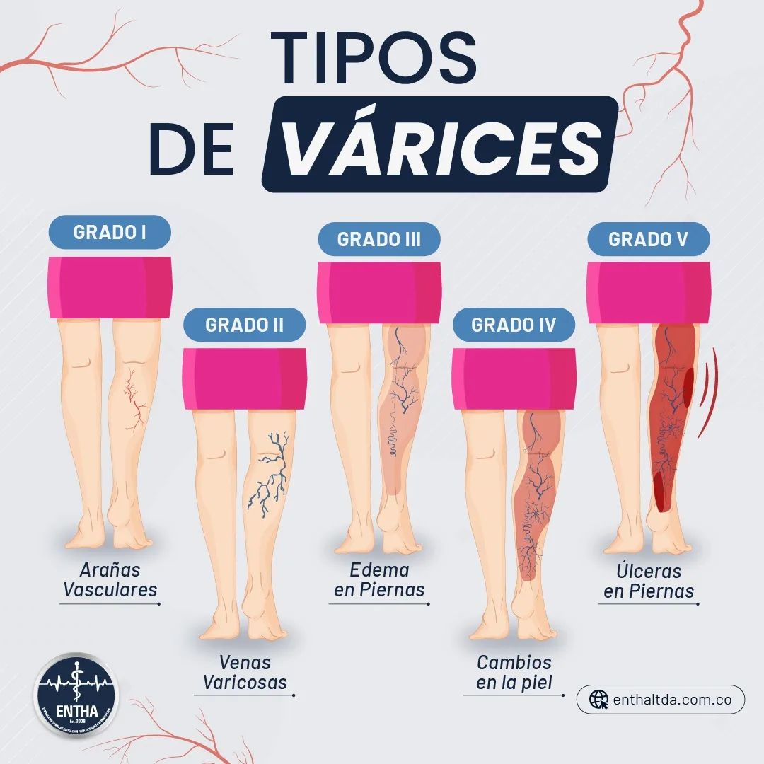 enthaltda's tweet photo. 🧬 Tipos de Várices.👇🏼
📌 Bibliografía: enfermedades venosas Dr. Francisco Valdés E.
#varices #arañasvasculares #venasvaricosas #venasvarices #edemas #fisioterapia #fisioterapeuta
#varices #arañasvasculares #venasvaricosas #venasvarices #edemas #fisioterapia #fisioterapeuta https://t.co/NfWlBStOGt