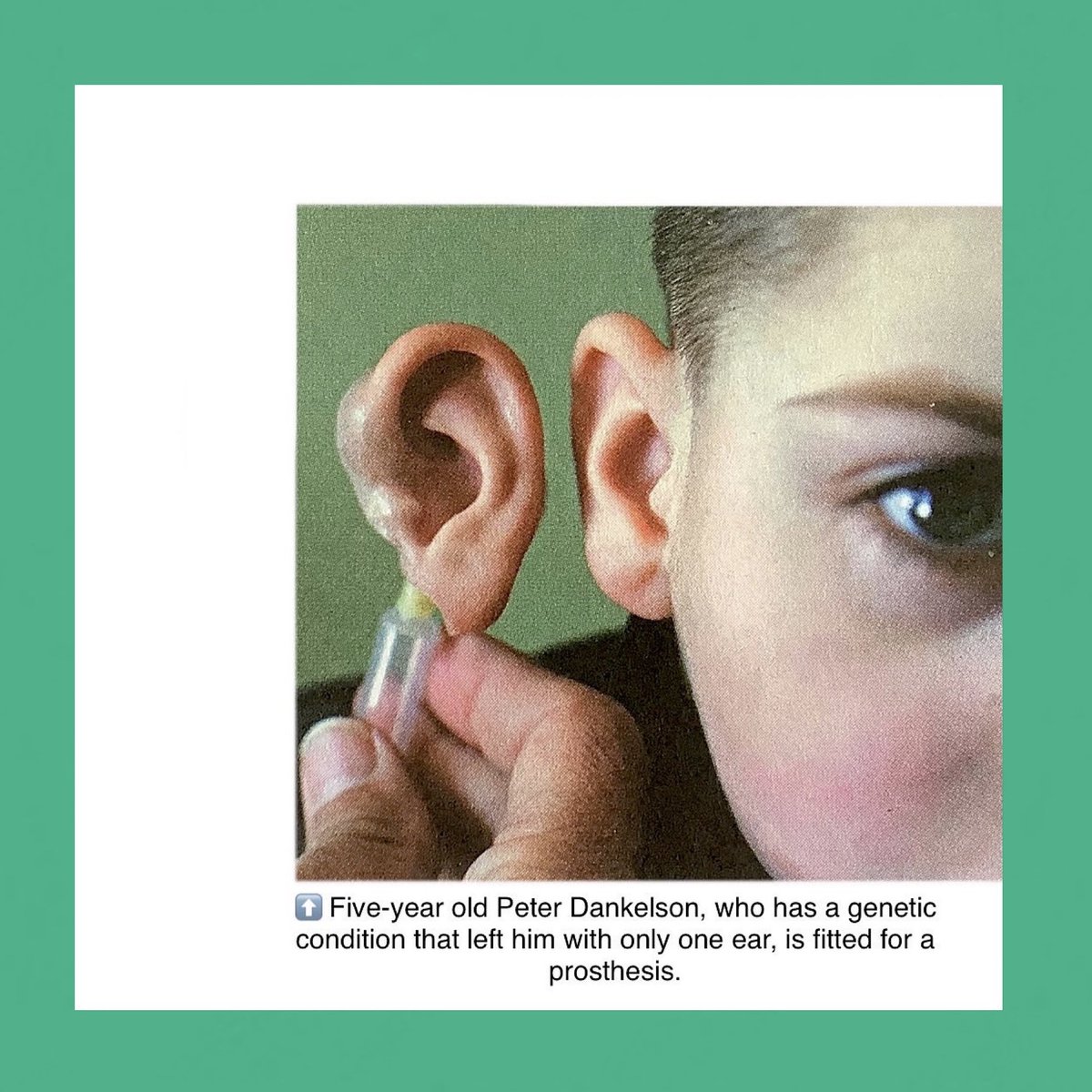 nikkifirewall's tweet image. @Technology/#Prosthesis/#ProstheticSolutions/#Medical-Australia has an outstanding history in prostheses, with a team of Melbourne medical professionals creating the cochlea ear implant in 1982. Now the same technology has been applied to designing a bionic eye, using a