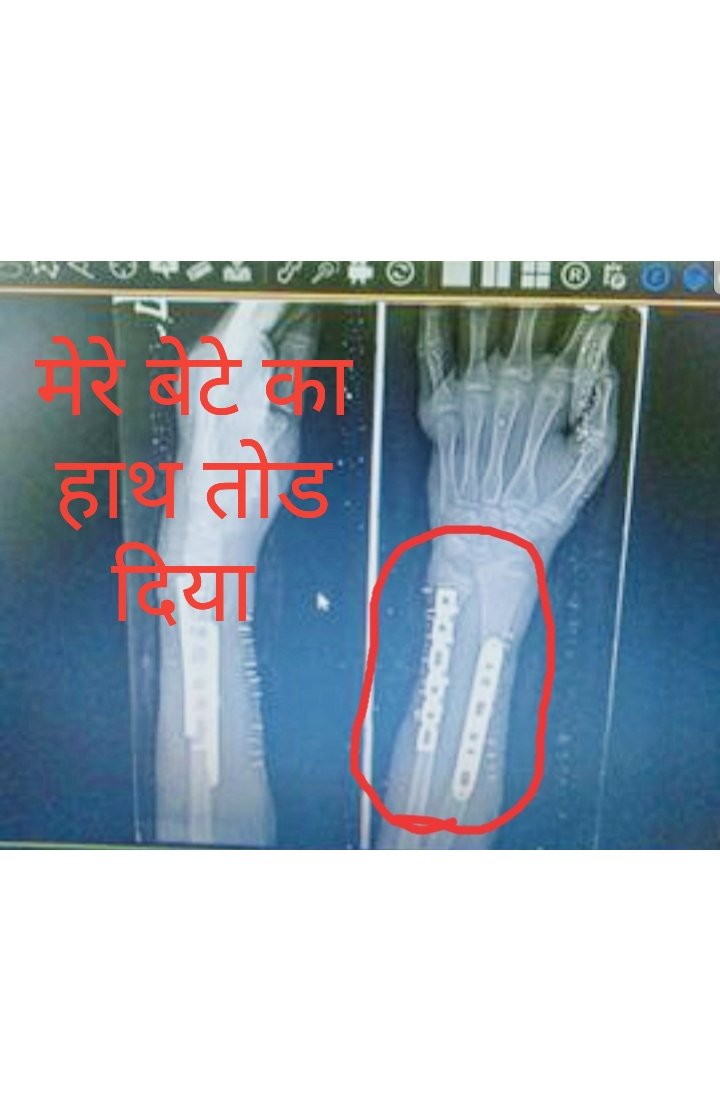<a href="/anilvijminister/">Anil Vij Ambala Cantt Haryana, India</a> #जीभ_काट_दी ✋ तोड़ दिया #गाड़ी_छीन_कर_रोजी_रोटी_छीन ली गाड़ी वापिस देने के लिए #अवैध_पैसे की मांग जिसका जिम्मेदार #मोहनराज है।
<a href="/gurgaonpolice/">Gurugram Police</a> ने <a href="/rashtrapatibhvn/">President of India</a>  जी के आदेश की अव्हेलना। #माननीय_गृहमंत्री जी सिर्फ हवाबाजी कर रहे हैं।आदेश पर झूठी ATR 
#ब्राह्मण_विरोधी_BJP