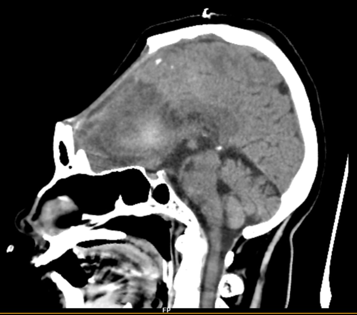 Clinical pearl; "Syndrome of the trephined" or "sinking skin flap syndrome"- an iatrogenic complication in  which neurological deterioration occurs following craniectomy. Atmospheric pressure is > ICP and leads to slow brain herniation.