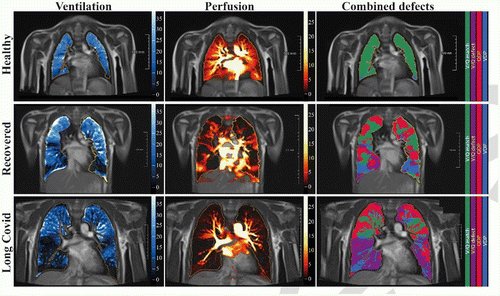 Perbess's tweet photo. RM funcional 0.55T de pulmón #PREFUL
Defectos de ventilación (azul) y perfusión (rojo)
Ventilación/perfusión V/Q (verde)
Defectos de V/Q (morado)
•Sup: control sano (varón de 7 años)
•Centro post COVID-19 (varón de 10 años)
•Inf LongCOVID (varón de 15 años) https://t.co/Qsyf4ruYJF