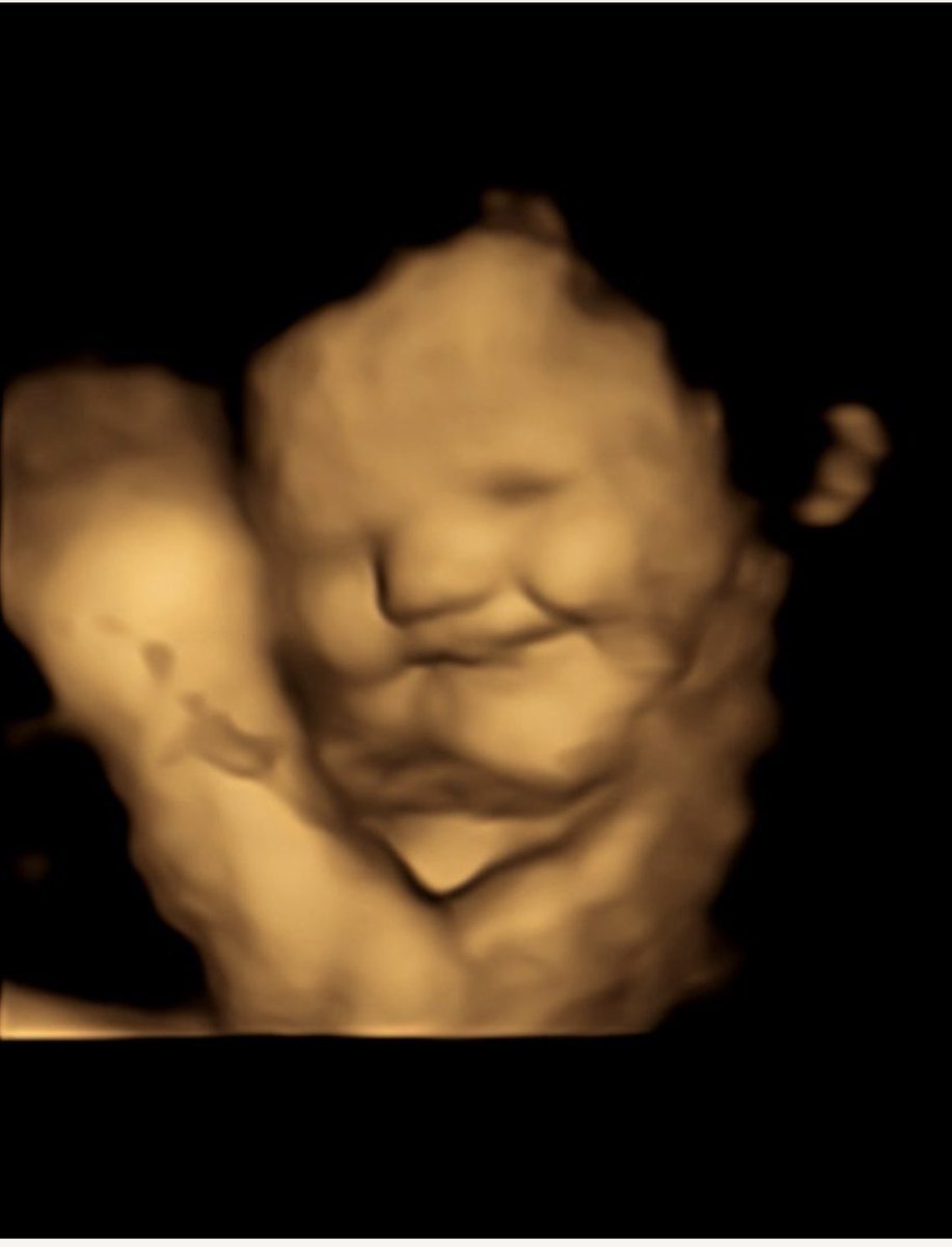 profblissett's tweet image. So here it is. The first direct evidence that the human fetus shows facial responses to flavours from maternal diet. Can you guess which fetus’s mum had kale, and which had carrot? @AstonPsychology @AstonPeach @Aston_IHN link to study in comments.