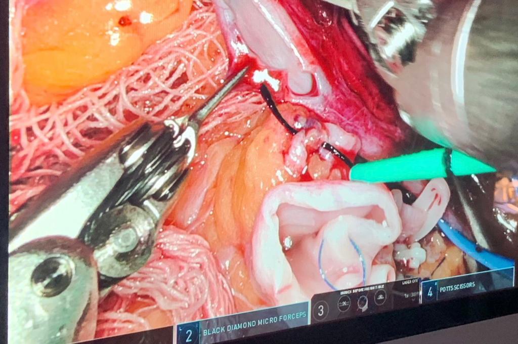 SJHDELHI's tweet photo. First robotic renal transplant of Indian Central Govt Hospital was performed successfully @SJHDELHI by Dr Anup Kumar,HOD Urology with the team of Dr Himanshu Verma HOD Nephrology &amp; DrMadhu Dayal from Anaesthesia. This was possible by all administrative support of Dr BL Sherwal MS https://t.co/eey71Ngr6V