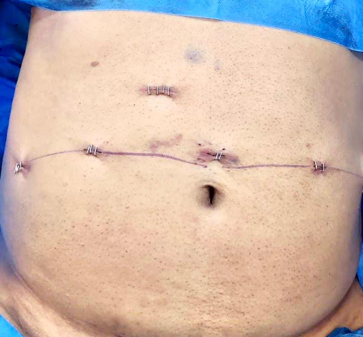 SJHDELHI's tweet photo. First robotic renal transplant of Indian Central Govt Hospital was performed successfully @SJHDELHI by Dr Anup Kumar,HOD Urology with the team of Dr Himanshu Verma HOD Nephrology &amp; DrMadhu Dayal from Anaesthesia. This was possible by all administrative support of Dr BL Sherwal MS https://t.co/eey71Ngr6V