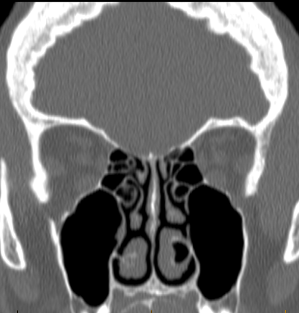 DrScottFortune's tweet photo. Small debate: interesting finding on #sinusctscan Concha bullosa of #inferiorturbinate or aeration of maxillary sinus into inferior turbinate? You decide and leave #comments https://t.co/5w42xfg84P
