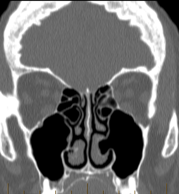 DrScottFortune's tweet photo. Small debate: interesting finding on #sinusctscan Concha bullosa of #inferiorturbinate or aeration of maxillary sinus into inferior turbinate? You decide and leave #comments https://t.co/5w42xfg84P
