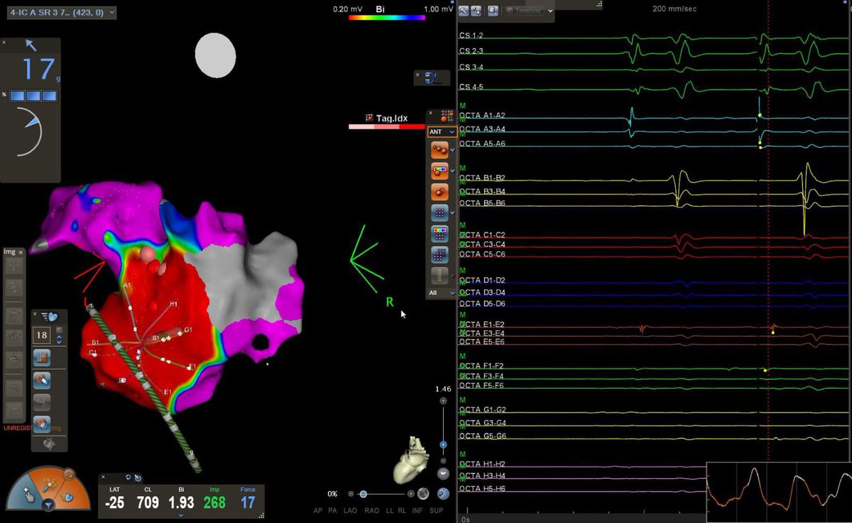 Laila_G's tweet photo. Initial experience (8 cases) in our center with octaray catheter CARTO 3. Great EGMs and maps. @JosMart42952309 @javiergseara @MoisesManero @cardiologiaCHUS https://t.co/kC2pHbd82S