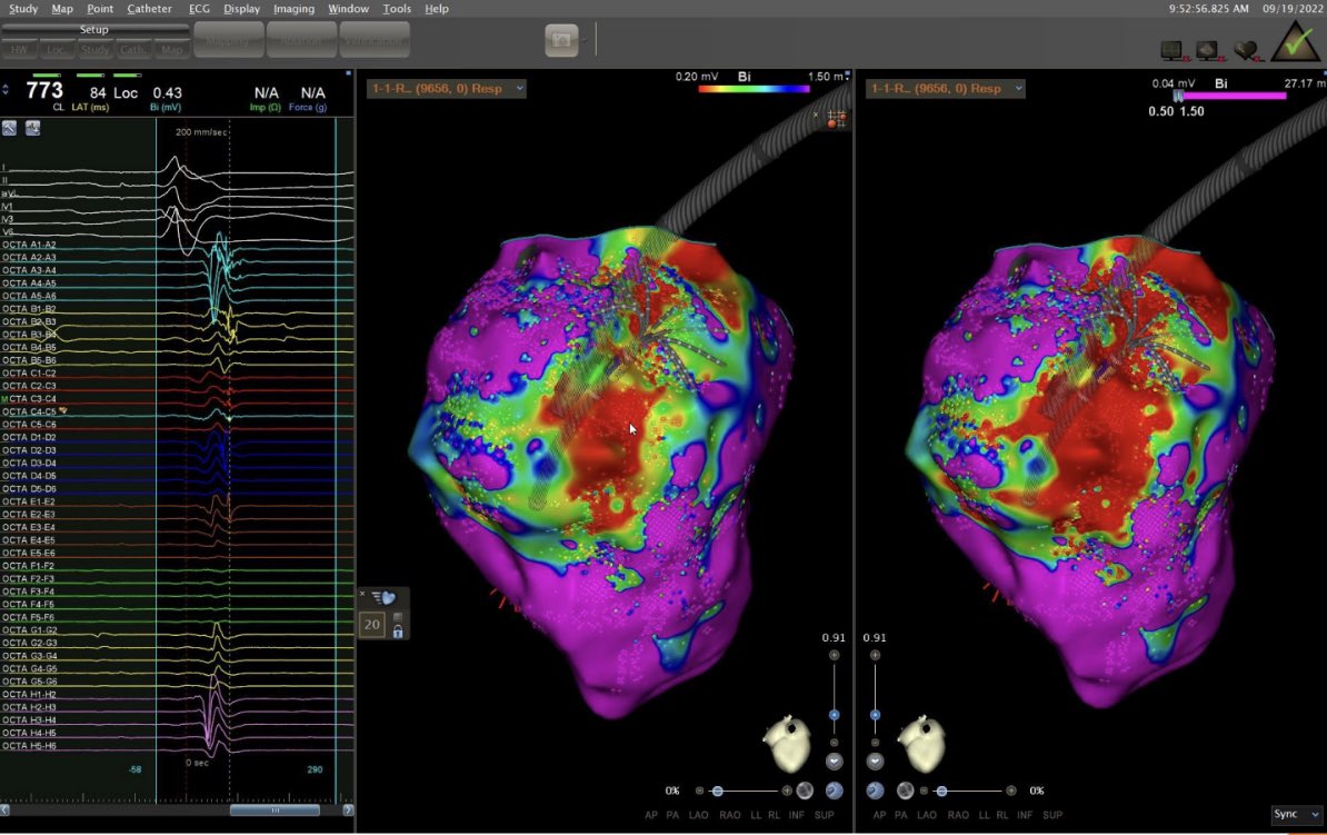 Laila_G's tweet photo. Initial experience (8 cases) in our center with octaray catheter CARTO 3. Great EGMs and maps. @JosMart42952309 @javiergseara @MoisesManero @cardiologiaCHUS https://t.co/kC2pHbd82S