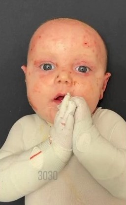 erak_iva's tweet photo. Viktorovo previjanje traje po 4-6 sati dnevno, a radi se specijalni zavojima koji imitiraju kožu i sprečavaju sepsu. Plikovi se stvaraju i na sluznicama. Mi smo nada da će mu lek biti dostupan pre nego što #EpidermolysisBullosa napravi nepovratnu štetu.
Svi za lek!
1339 na 3030 https://t.co/UTdOrpRkYi