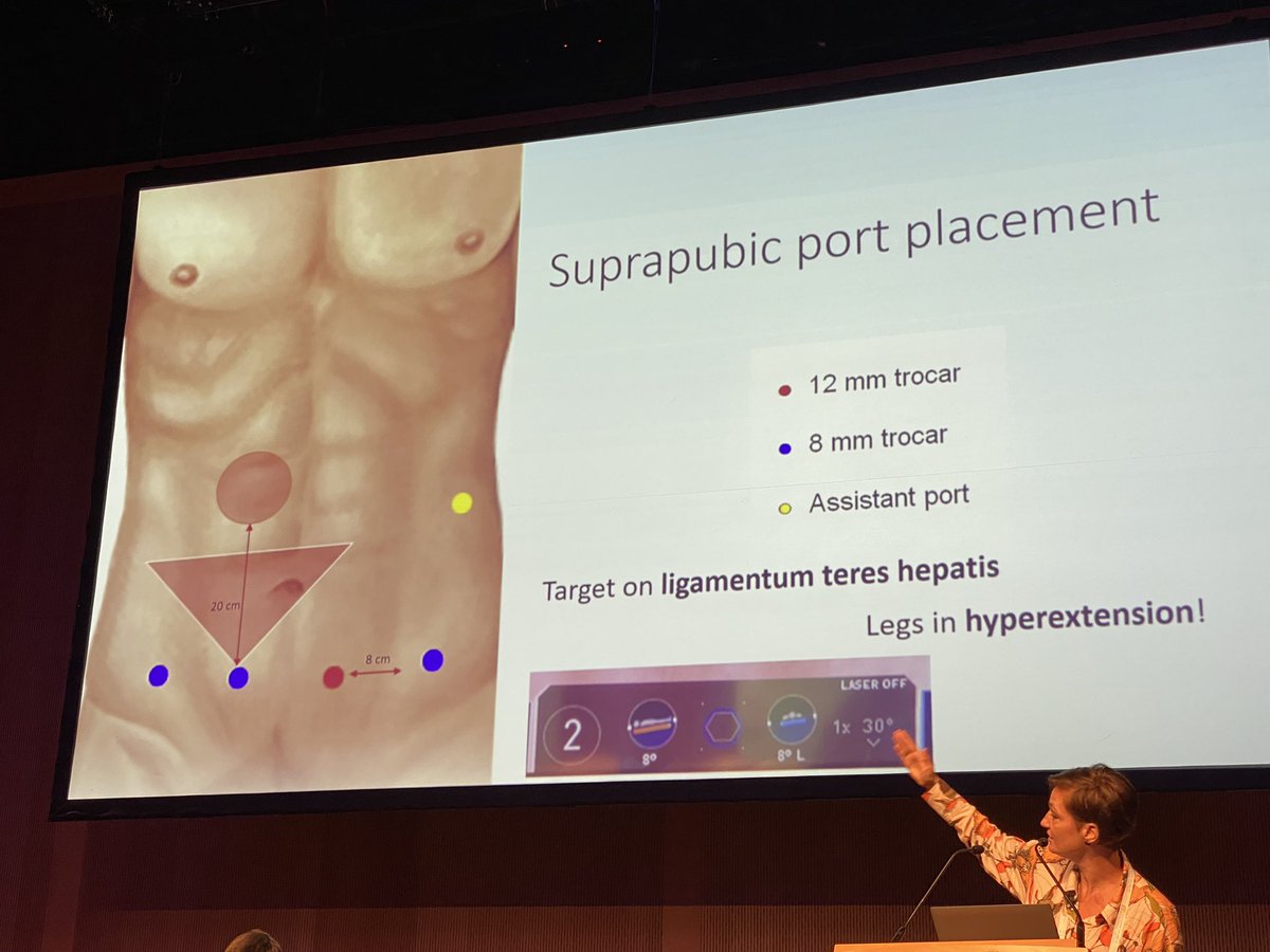 Excellent presentation of <a href="/EllenEetvelde/">Ellen Van Eetvelde, MD</a> about implementing robotic CME for right colon cancer #ESCP2022 <a href="/IntuitiveSurg/">Intuitive</a>
