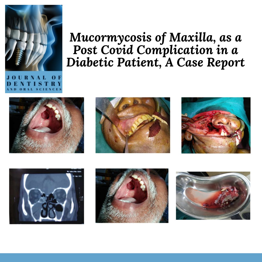Recent publication "Mucormycosis of Maxilla, as a Post COVID Complication in a Diabetic Patient, A Case Report"

Read the full-length article via following link: doi.org/10.37191/Mapsc…

#mucormycosis #maxillofacial #diabetes #casereport #covid