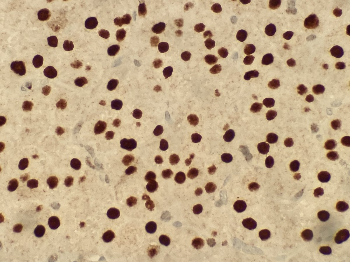 Patologica_HAC's tweet photo. 👦🏼7-year old boy  
📌sexual precocity
🥚1.3 cm testicular tumour https://t.co/bl4UAPc910