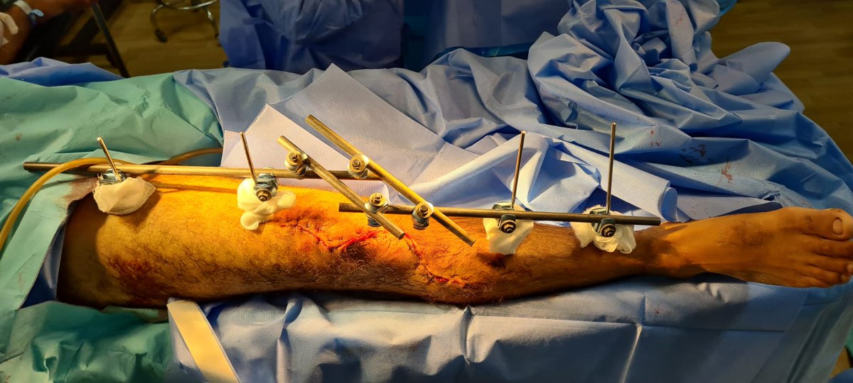 G3RSONV's tweet photo. @doctorvidela @Gnomelover1970 @InvictaOrtho @traumaticum @MrJKotto @generalorthomd taking into account the original soft tissue injury, i would say yes @doctorvidela (picture after debridement) https://t.co/YseBj4dyf5